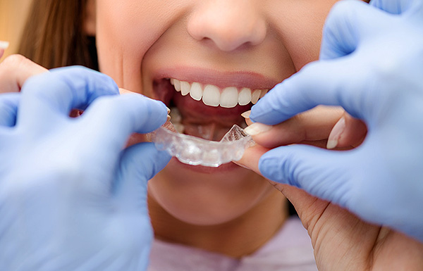 Çeşitli ortodontik kapakların yardımıyla yanlış ısırmayı düzeltmekten bahsedelim ...