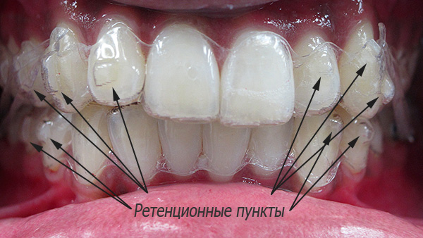 Puntos de retención en los dientes.