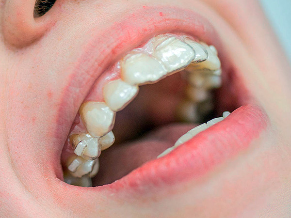 El propio médico puede hacer un kapu para corregir la posición de uno o varios dientes ...