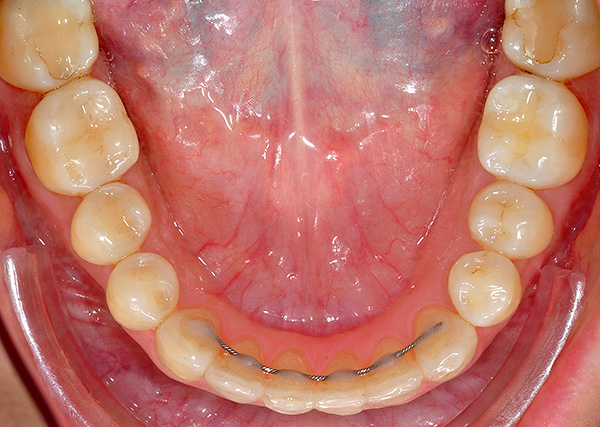 Retenedor en los dientes frontales de la mandíbula inferior.