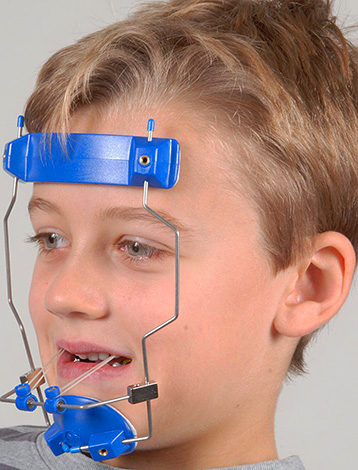 이러한 구강 장치를 착용하면 아이가 위턱을 앞으로 움직일 수 있습니다.
