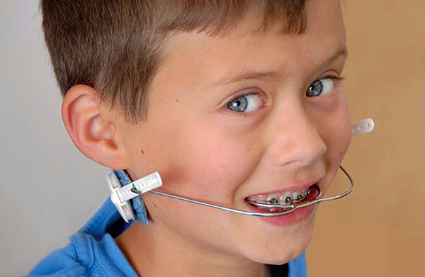 Vòm mặt cho phép, ví dụ, để thiết lập độ nghiêng của răng trước vào khoang miệng.