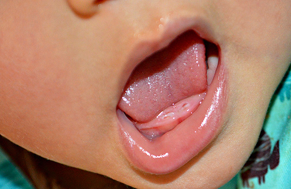 Ya en la infancia, varios factores pueden tener un impacto negativo en la mordedura de leche del niño.