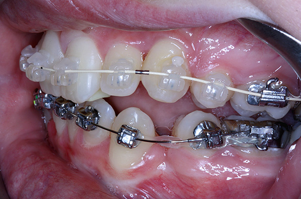 Khi đeo niềng răng, có thể có một số vấn đề mà nó rất hữu ích để biết trước ...