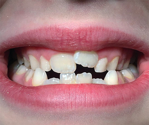 Diversos tipos de aparatos de ortodoncia removibles permiten nivelar efectivamente la mordida en niños, incluso en casos clínicos muy difíciles ...