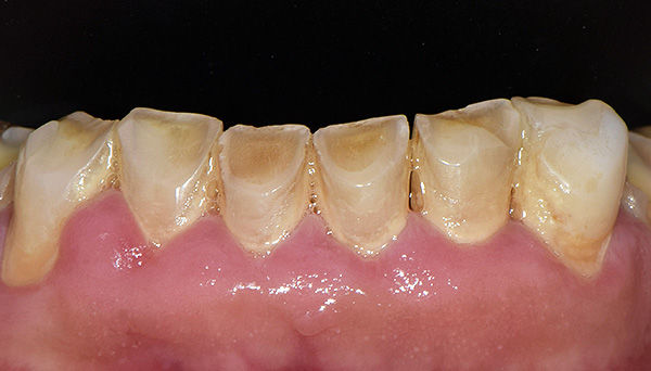 Yanlış tıkanıklık, alt kesici dişlerin ve köpek dişlerinin anormal aşınmasına neden olmuştur.