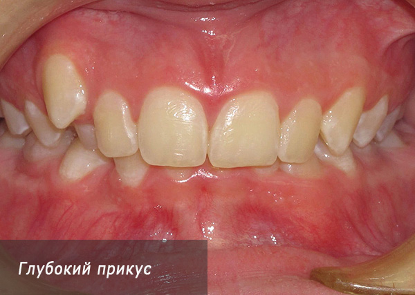 Derin bir tıkanıklıkla, alt kesici dişler genellikle damağa zarar verir.