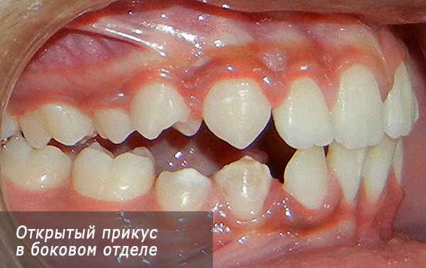 Dişlerin lateral kısmında açık lokma.