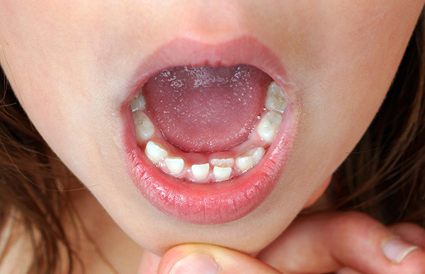 Cuando se cambian los dientes de leche a los permanentes, a menudo es posible observar signos de futuros problemas de mordedura ...
