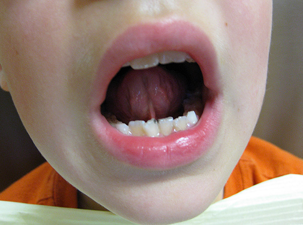 Κατά την περίοδο της εφηβείας οι έφηβοι έχουν ένα στάδιο ενεργητικής αναδιάρθρωσης ολόκληρου του συστήματος δοντιών-δοντιών.