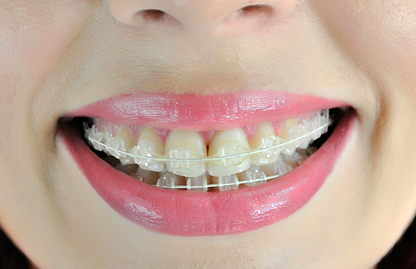 Safir diş telleri, metal diş tellerine kıyasla, dişlerde nispeten göze çarpmaz.
