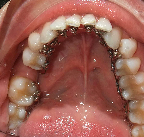 Bireysel olarak 3D lingual diş teli.
