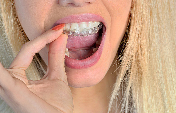 Ortodontik bir kapak, kalıcı dişlerin ısırmasını düzeltmek için nasıl görünür.
