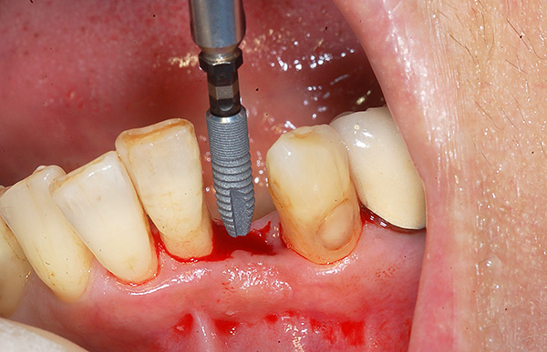 Bir dişin kaybı ile, diş implantasyonu genellikle protezler için en iyi seçenektir.