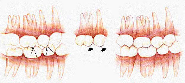 Engelleme diş temaslarını ortadan kaldırmak için şeması.