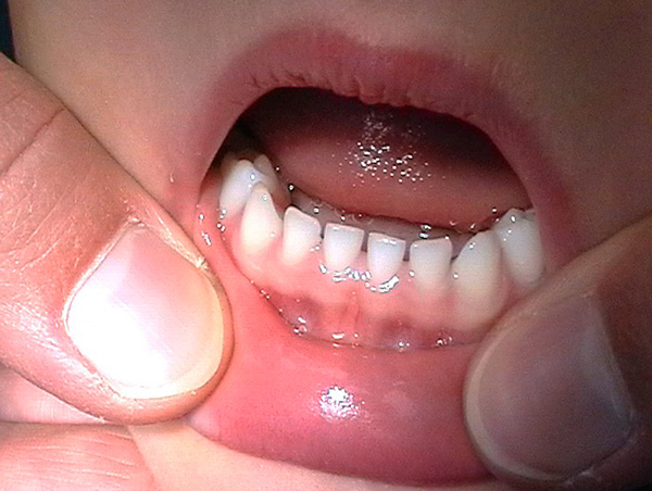Las grandes brechas entre los dientes de leche no son patológicas.