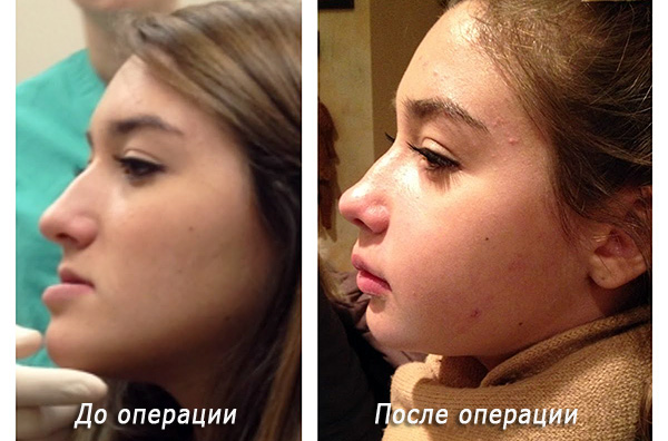 Ortognatik cerrahinin sonucu: sol - ameliyattan önce, sağdan - sonra.