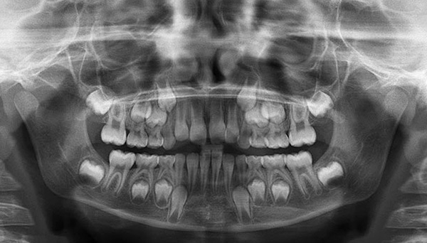Así es como se ven los rudimentos de los dientes permanentes en una radiografía.