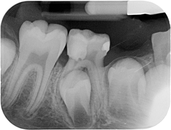La mineralización de los tejidos del germen de un diente permanente comienza en los primeros meses de vida de un niño.