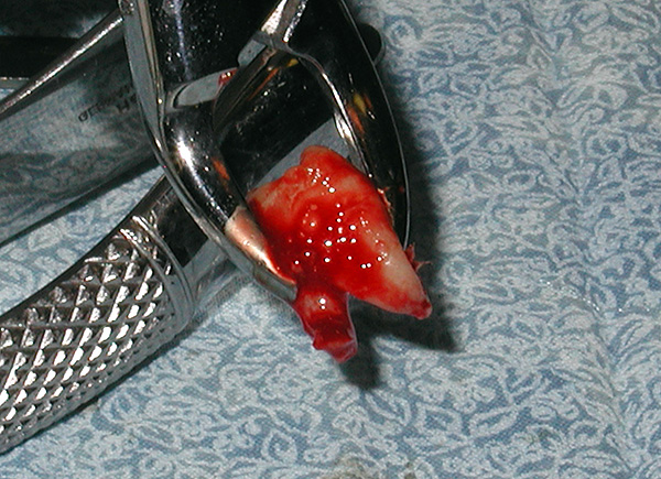 A menudo, con el tratamiento de ortodoncia, es necesario eliminar los ochos.
