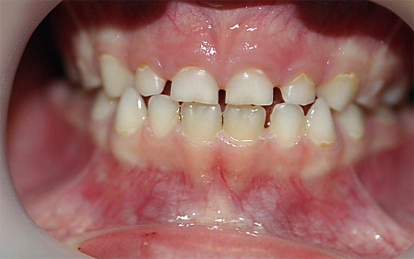 في مرحلة معينة ، قد تخضع أسنان الحليب لخدش فسيولوجي كبير.