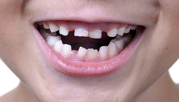 خلال فترة تغيير أسنان الحليب إلى عضة ثابتة ، قد يكون الطفل بعيدًا عن المثالية.