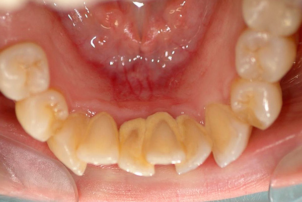 Das Gedränge der unteren Schneidezähne verursacht Schwierigkeiten bei der Hygiene und trägt zur Bildung von Zahnstein bei.