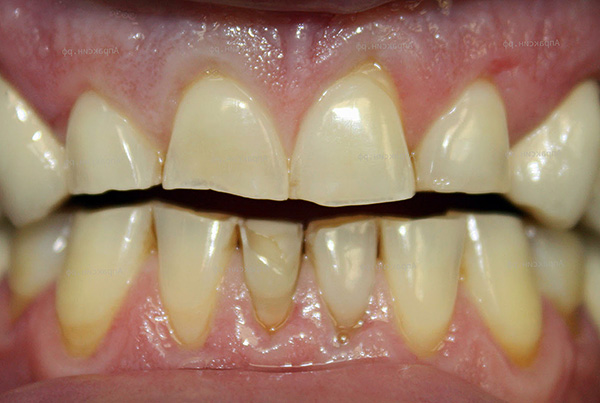 غالبًا ما تؤدي اللسعة غير الصحيحة إلى محو شديد للأسنان الفردية.