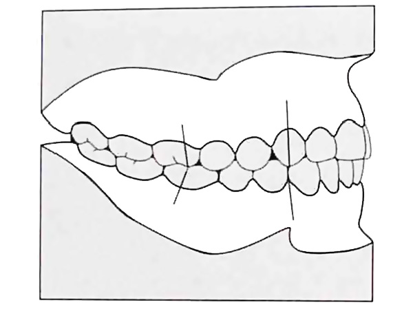 Sự đóng cửa của răng trong lớp I của góc