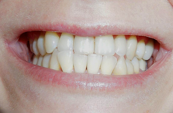 Với vết cắn trực tiếp theo độ tuổi, có một vết cắt mạnh mẽ của các cạnh cắt của răng cửa trên và dưới.