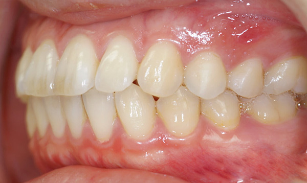 En caso de mordida biprognática, los dientes frontales superiores e inferiores están fuertemente doblados hacia adelante.