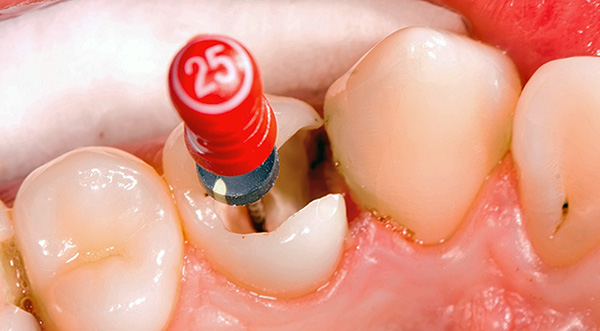 Intentemos averiguar por qué un diente puede doler durante mucho tiempo después del tratamiento de la pulpitis ...