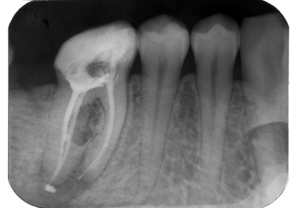 La sortie du matériau d'obturation au-delà du sommet de la racine de la dent peut entraîner une douleur post-remplissage prolongée.