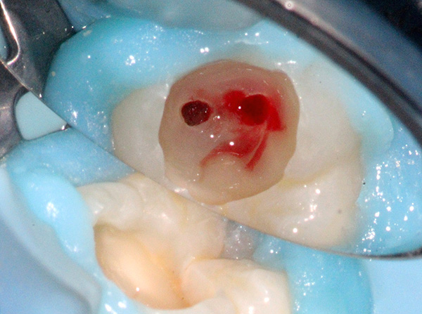 Diş kanal tedavisi oldukça travmatik bir işlemdir.