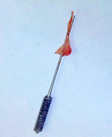 La photo montre la pulpe retirée du canal dentaire.