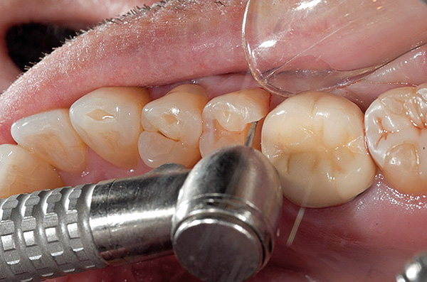 Cuando se procesa un diente con un taladro, se produce un fuerte calentamiento del esmalte dental, la dentina y el boro giratorio.