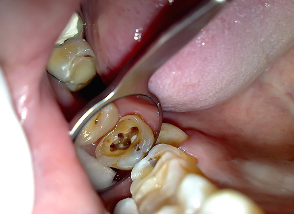 이것은 씹는 치아의 근관의 입입니다.