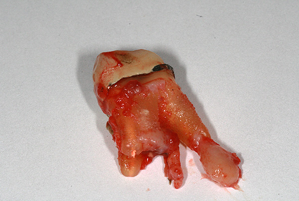 Pulpitisin tedavisinde yapılan hatalar, dişin kökleri üzerinde kist oluşumuna yol açabilir.