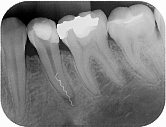 Рентгеновите лъчи ясно показват счупено парче зъбен инструмент, залепен в кореновия канал.